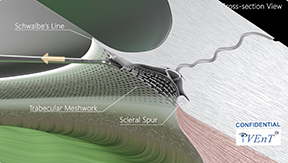 Animated Video of the iVent Procedure