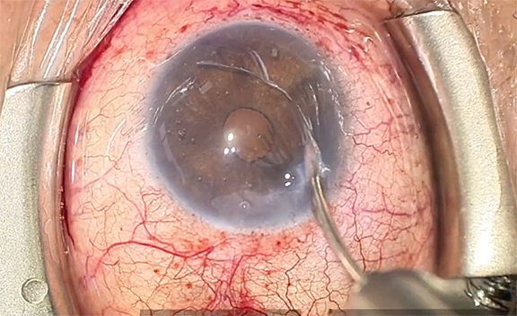 Enhancing Outflow With iTrack and Allo-Flo