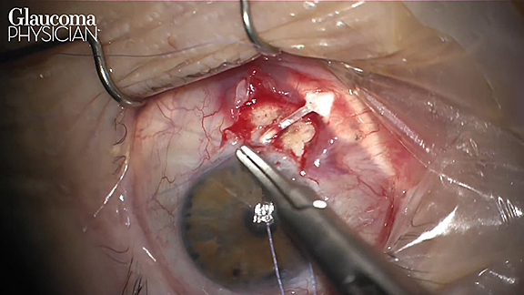 Glaucoma Drainage Implant Revision Using Scleral Plug