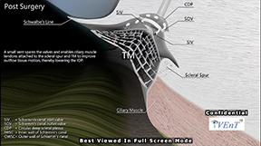 The Outflow System Before and After iVent