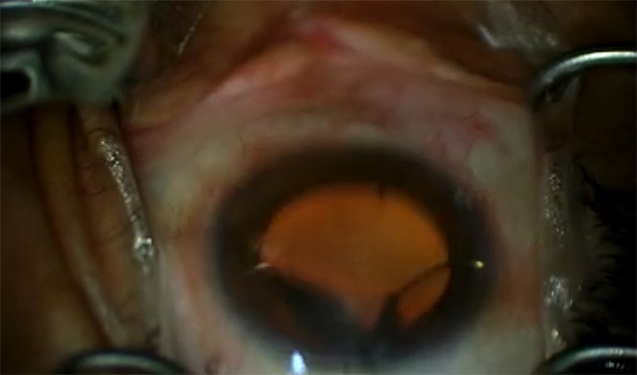 Novel Single-Surgeon Technique for 360° GATT