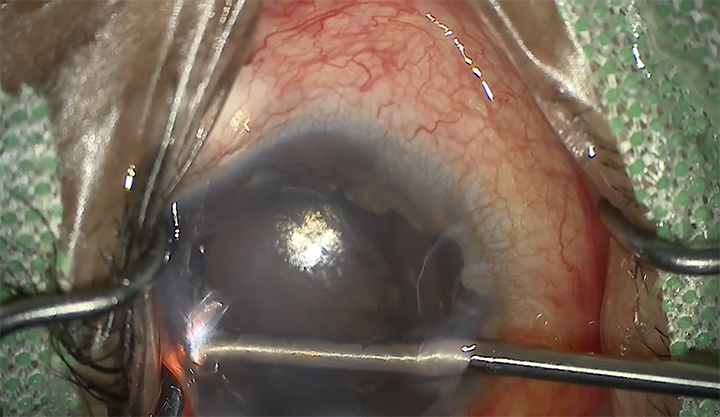 ECP as a Hemostatic Tool for Ciliary Body Hemorrhage